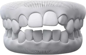 invisalign Teeth